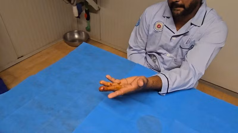 Ngón tay của bệnh nhân sau khi được phẫu thuật đang phục hồi tốt. (Ảnh: SỸ CÔNG)