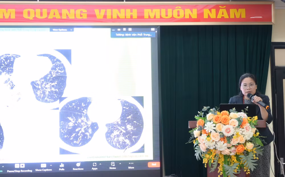 Tiến sĩ, bác sĩ Nguyễn Thị Bích Ngọc chia sẻ về phương pháp phát hiện, điều trị bệnh nấm phổi.