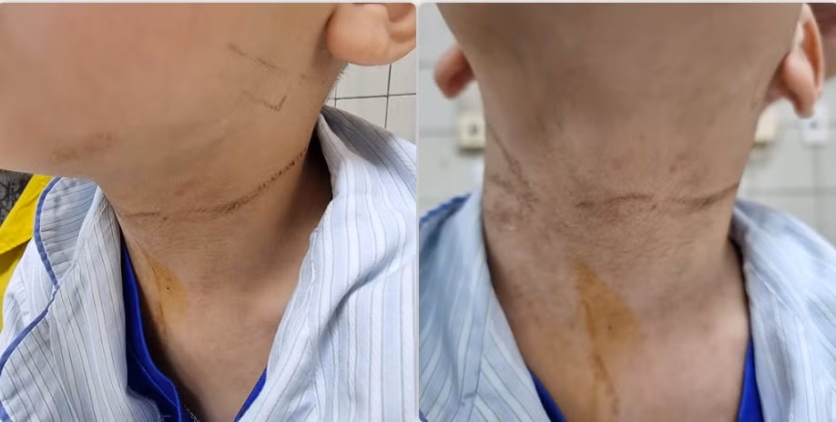 Hình ảnh vết dây thắt ở cổ bệnh nhi.