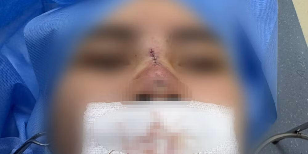 Bệnh nhân bị hoại tử mũi sau nâng mũi căng chỉ ở một cơ sở thẩm mỹ không uy tín.