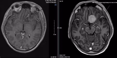 Phim chụp MRI trước mổ (bên phải) và sau mổ (bên trái) cho bệnh nhân. Phim chụp MRI trước mổ (bên phải) và sau mổ (bên trái) cho bệnh nhân.