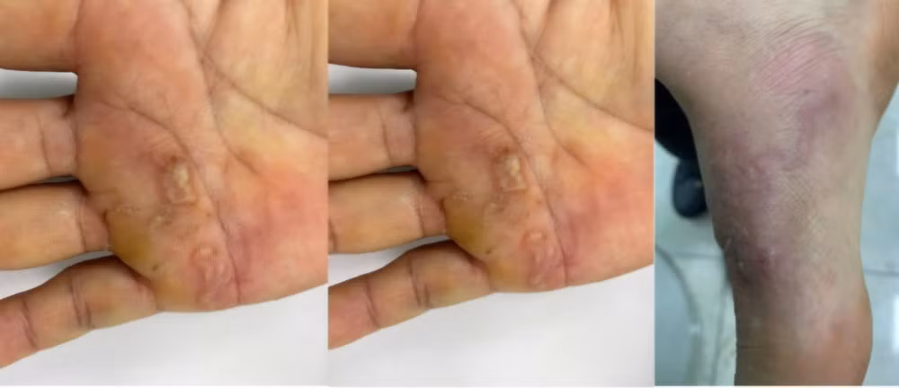 Bệnh ấu trùng di chuyển ở da (Cutaneous larval migrans – creeping eruption) do ấu trùng giun sán có trong nước lũ xâm nhập vào da.