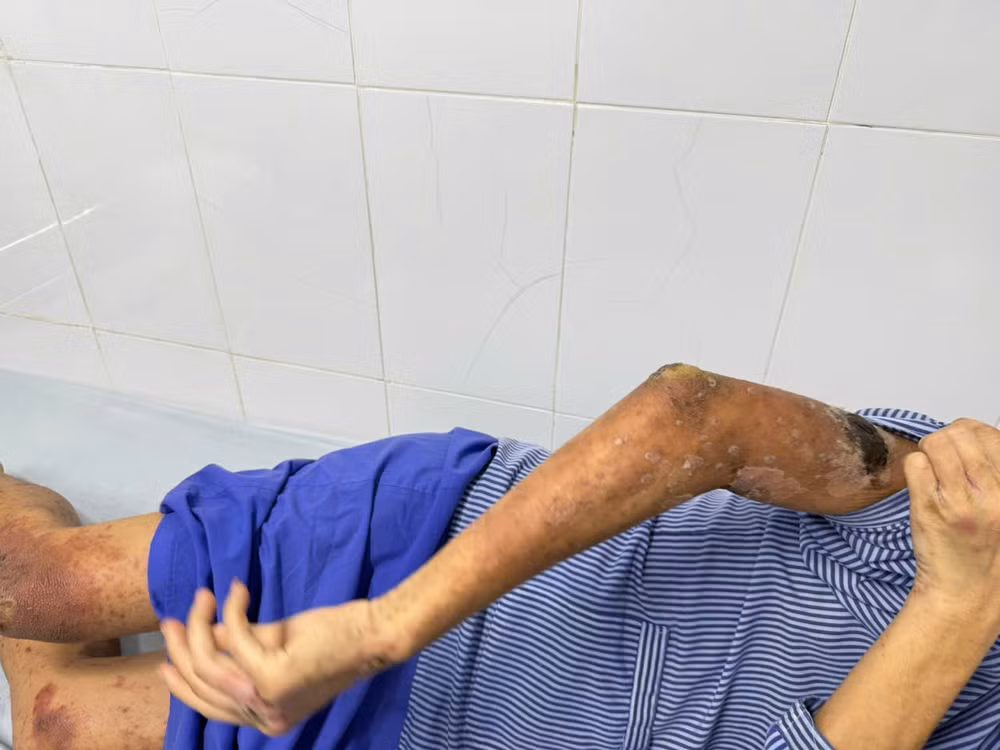 Bệnh nhân nhiễm trùng toàn thân.