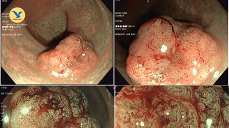 Hình ảnh nội soi phóng đại tìm thấy polyp trực tràng, kích thước gần 3cm, O-Isp, JNET 2A-B. Hình ảnh nội soi phóng đại tìm thấy polyp trực tràng, kích thước gần 3cm, O-Isp, JNET 2A-B.