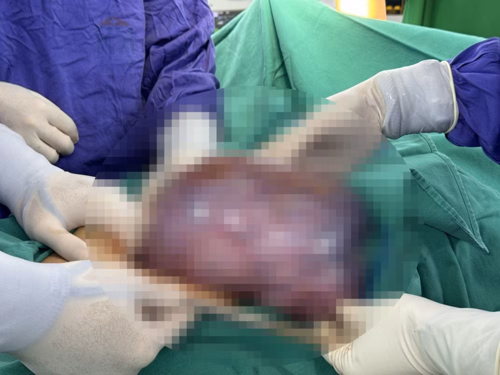 Khối u buồng trứng nặng gần 3kg được cắt bỏ thành công. Khối u buồng trứng nặng gần 3kg được cắt bỏ thành công.