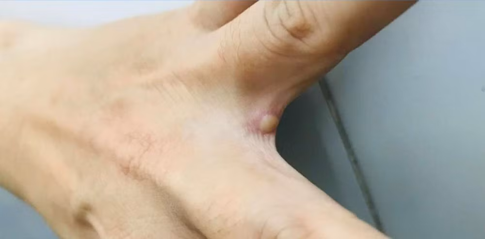 Bóng nước điển hình rải rác các vị trí khác nhau trên cơ thể người bệnh. (Ảnh: Bệnh viện cung cấp)
