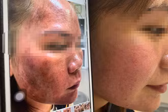 Bệnh nhân đã bớt phù nề, bỏng da sau một tuần điều trị.