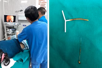 Kíp bác sĩ Khoa Nội soi tiêu hóa thực hiện gắp dị vật cho bệnh nhân N.