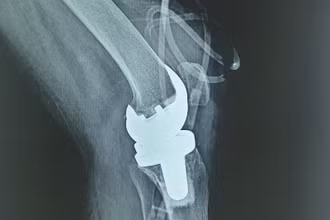 Bệnh nhân mắc lao khớp gối được thay khớp thành công. 