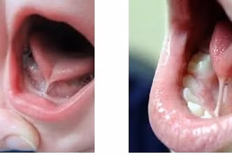 Trẻ mắc dị tật dính lưỡi.
