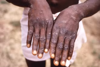 Bệnh nhân mắc đậu mùa khỉ tại Cộng hòa Dân chủ Congo. (Ảnh tư liệu: AFP/TTXVN)