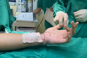Ca bệnh có bàn tay đứt lìa được nối ghép thành công.