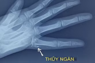 Hy hữu trẻ bị nhiễm độc thủy ngân qua da