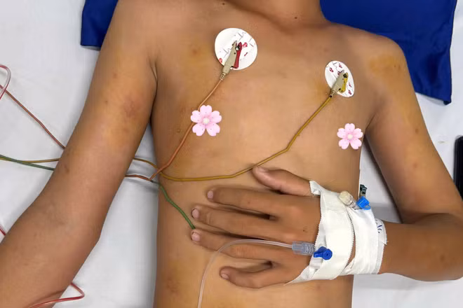 Bệnh nhi H. đã qua cơn nguy kịch và đang được tiếp tục chăm sóc, theo dõi tại Bệnh viện Sản-Nhi Cà Mau. (Ảnh do người nhà bệnh nhi cung cấp).