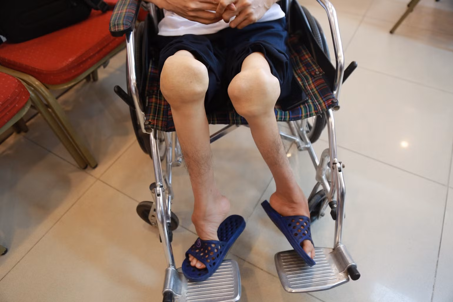 Điều trị dự phòng sẽ thay đổi tương lai cho người mắc bệnh hemophilia -0