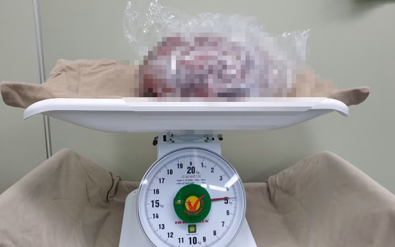 Đừng để căn bệnh GIST dạ dày lành tính trở thành ung thư -0