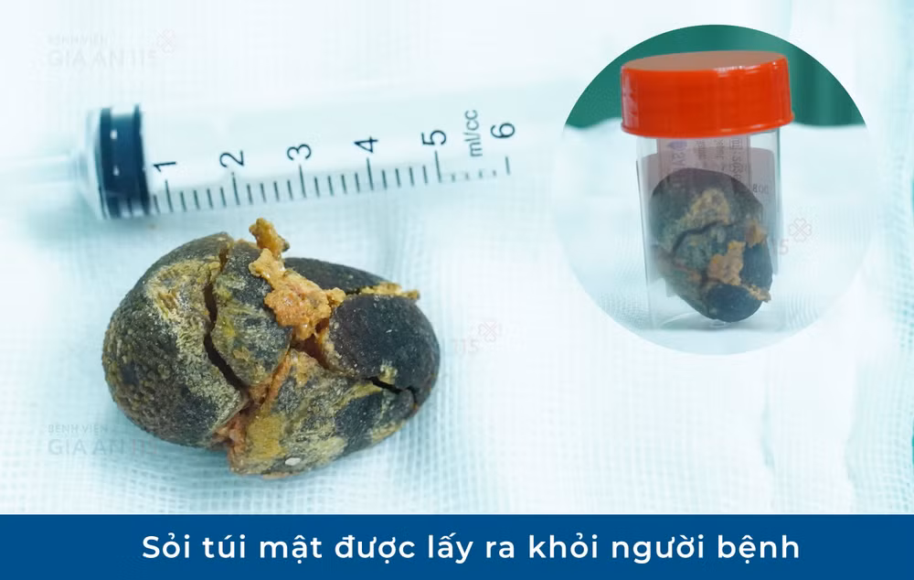 soi-tui-mat-duoc-lay-ra-khoi-nguoi-benh.jpg