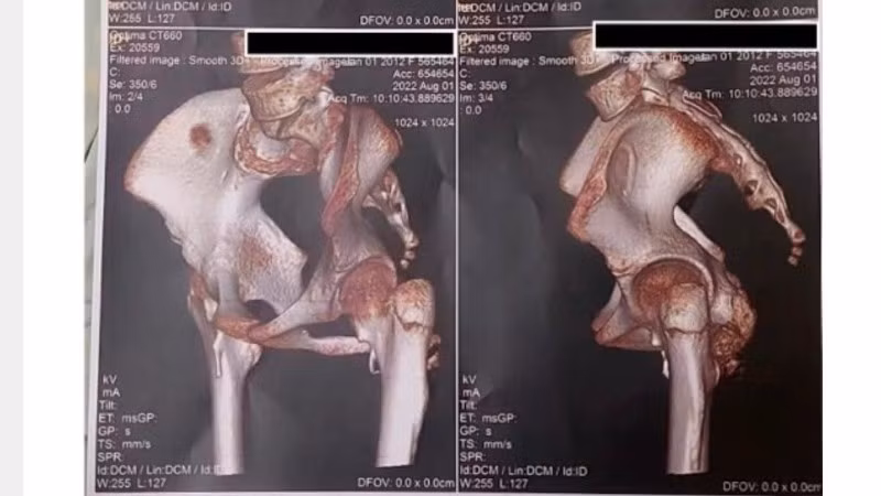Hình ảnh 3D từ chụp cắt lớp vi tính vùng khớp háng của bệnh nhân với hình ảnh canxi hóa mô mềm quanh khớp. (Ảnh: Bệnh viện cung cấp)