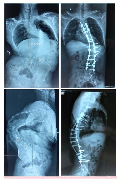 Phim chụp X-quang trước và sau phẫu thuật nắn chỉnh gù.