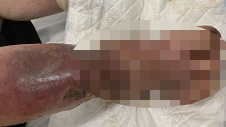 Tổn thương của bệnh nhân.