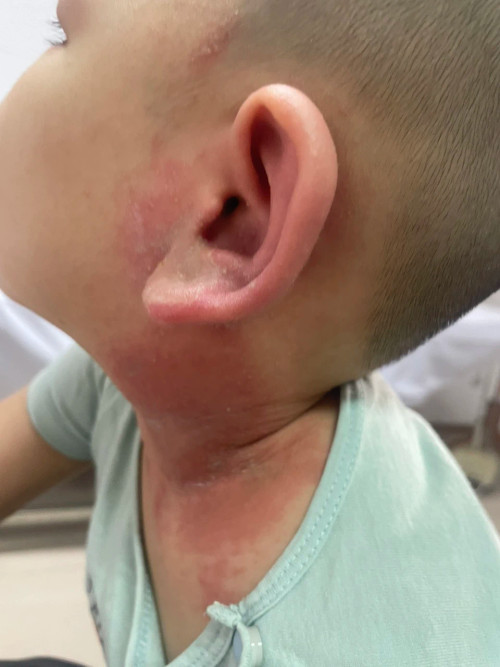 Bệnh nhi bị kiến ba khoang đốt.