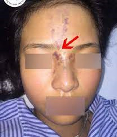 Bệnh nhân bị biến chứng tắc mạch, tắc động mạch võng mạc trung tâm dẫn đến mù mắt sau tiêm filler mũi.