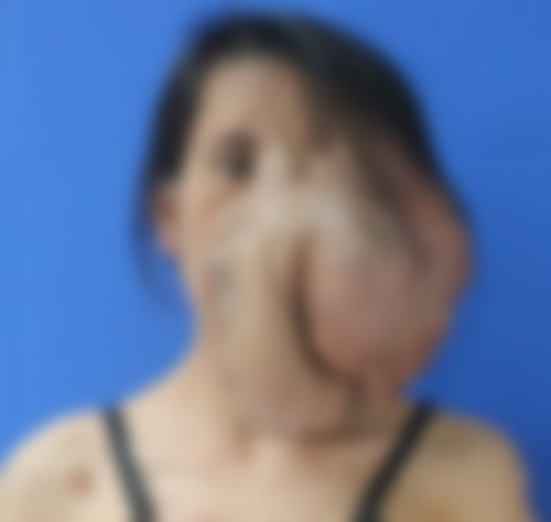 Khối u khổng lồ.