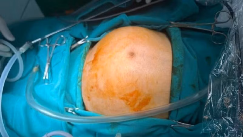 Hình ảnh bệnh nhân trước khi phẫu thuật, bụng phình to tương đương thai 7 tháng tuổi.