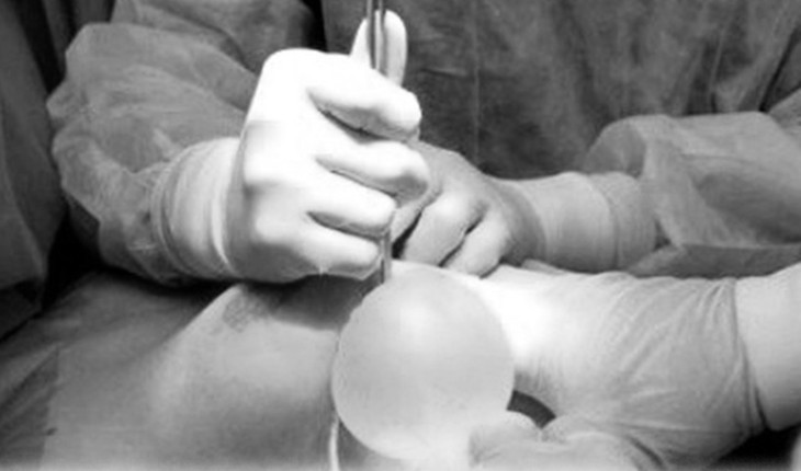 Các bác sĩ thực hiện phẫu thuật hút dịch mủ ngực cho bệnh nhân.