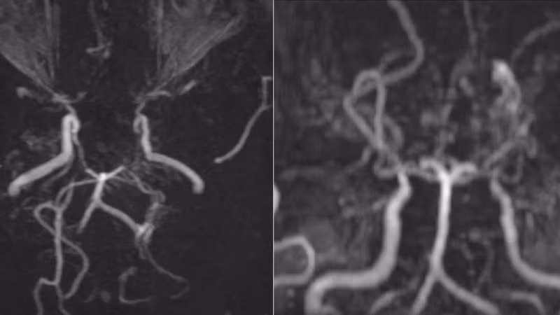 Các mạch máu não của bệnh nhân nhìn như “làn khói thuốc lá” trên phim chụp MRI