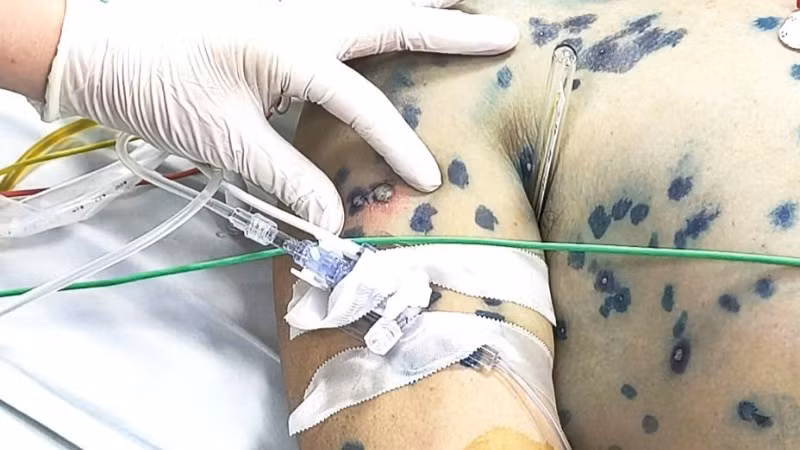 Ca bệnh mắc thủy đậu nằm điều trị tại Bệnh viện Bệnh Nhiệt đới Trung ương đặc biệt phức tạp khi bệnh truyền nhiễm bùng phát đồng thời với biến chứng ngoại khoa và nhiễm trùng huyết.