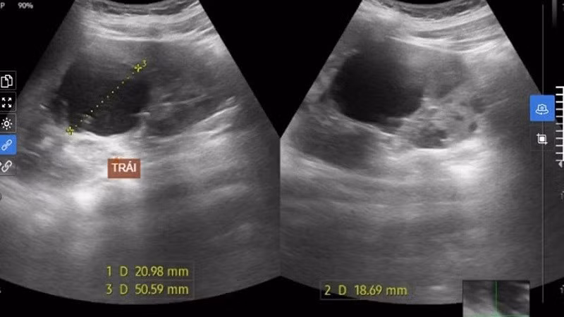 Hình ảnh siêu âm nang thận của bệnh nhân. 