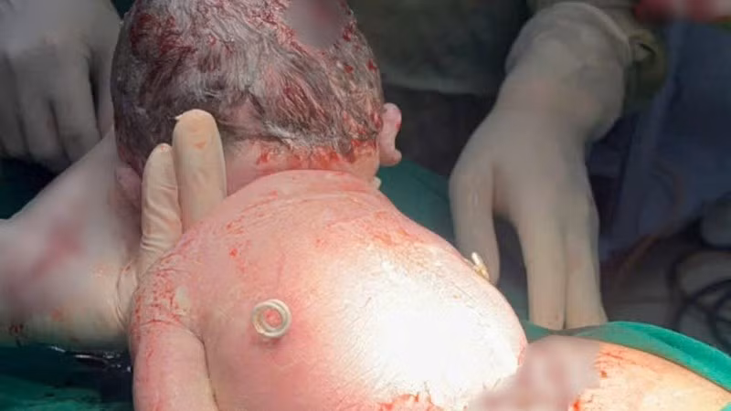 Em bé chào đời với "đôi cánh nhỏ" trên lưng.