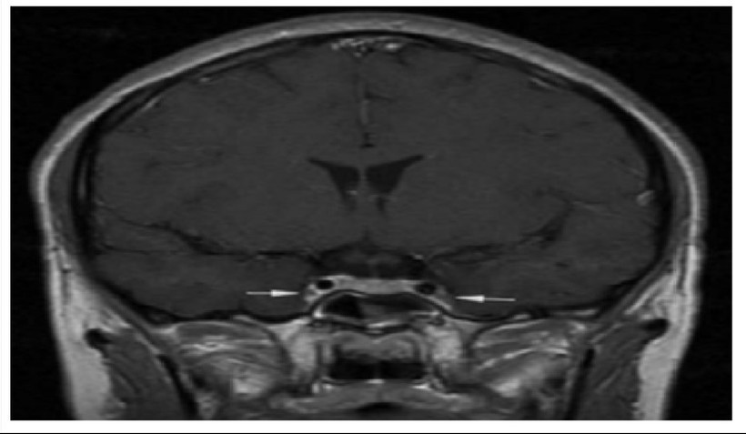 Vị trí mũi tên là viêm và co thắt động mạch cảnh trong 2 bên.