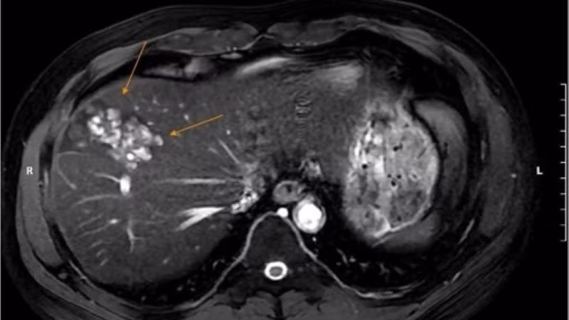 Hình ảnh tổn thương do sán lá gan. 