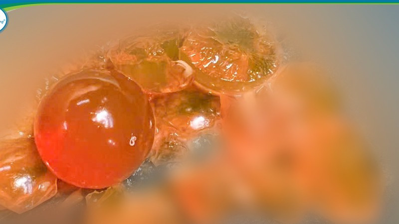 Dị vật được lấy ra là những hạt nhựa nhỏ, có khả năng trương nở khi gặp nước.