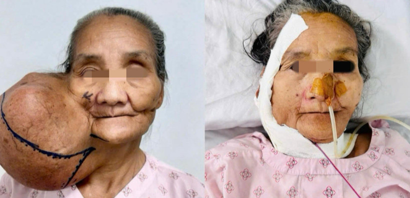 Bệnh nhân đã được phẫu thuật loại bỏ khối u khổng lồ. 