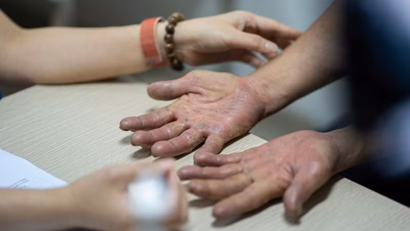 Bệnh da liễu bùng phát trong mùa nắng nóng, bác sĩ khuyến cáo cách phòng bệnh Bác sĩ khám cho người bệnh.