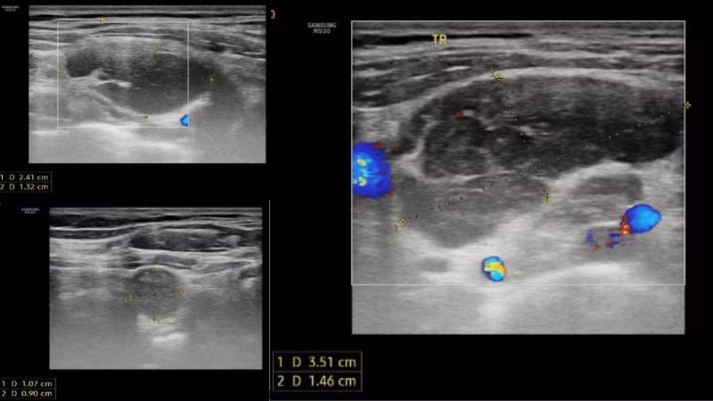 Kết quả siêu âm tuyến giáp ghi nhận hạch vùng cổ và hố thượng đòn hai bên.