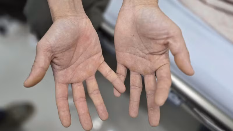 Bàn tay của anh H. bị tê bì, không thể khép lại và mất cảm giác.