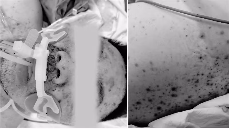 Bệnh nhân suy đa phủ tạng vì mắc thủy đậu. 