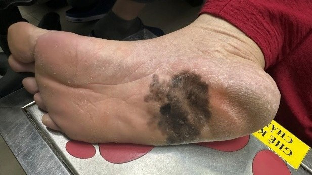 Hình ảnh ung thư tế bào hắc tố của bệnh nhân hơn 60 tuổi.