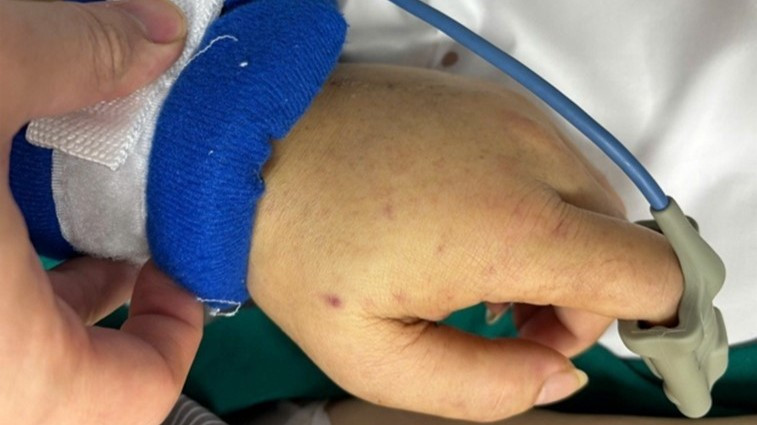 Ban xuất huyết trên cơ thể người bệnh.