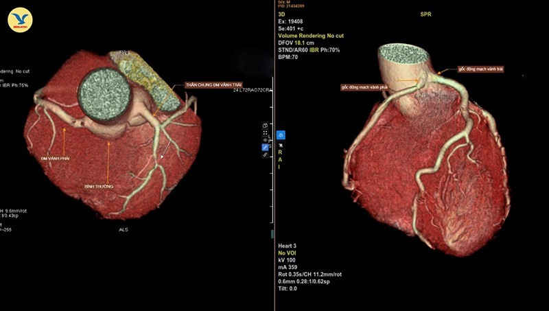 Hình ảnh chụp CTA 3D. Bên trái là động mạch vành bình thường. Bên phải là hình ảnh hai nhánh động mạch vành trái và phải xuất phát chung từ một gốc.