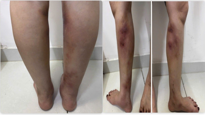 Hình ảnh tổn thương của người bệnh. 