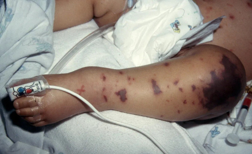 Tử ban do não mô cầu có đặc trưng là không biến mất khi dùng một vật trong suốt như ly thủy tinh ấn lên da. (Ảnh: Meningitis Research Foundation)