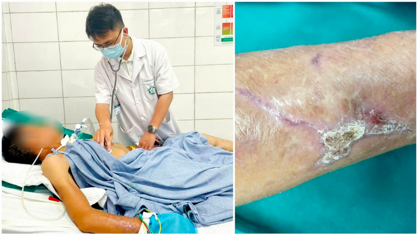 Bệnh nhân nằm điều trị tại Bệnh viện Bạch Mai do uốn ván. 
