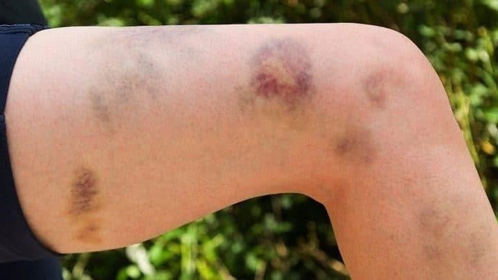 Vết bầm tím trên cơ thể là một trong những dấu hiệu của bệnh TTP.