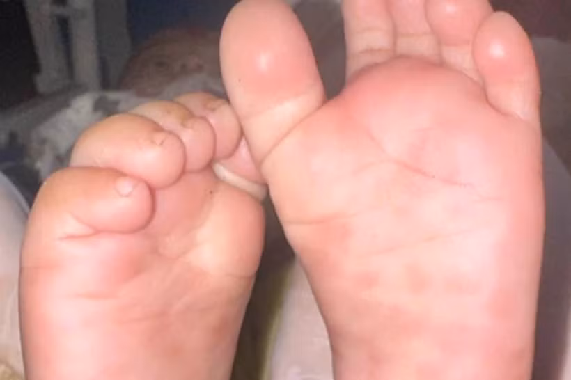 Vết ban rải rác ở gan bàn chân trẻ mắc giang mai bẩm sinh ở trẻ có triệu chứng, tổn thương. (Ảnh minh họa: Bệnh viện Da liễu Trung ương).