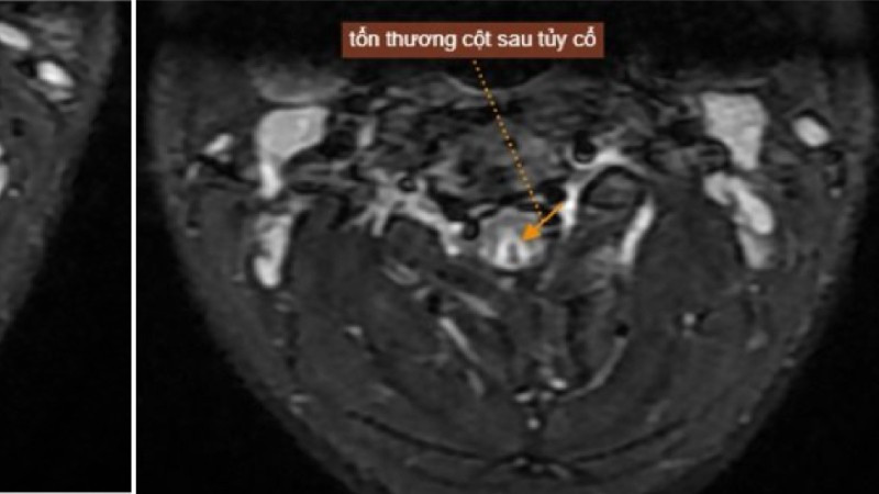 Tổn thương của nam thanh niên sau khi hút bóng cười. 